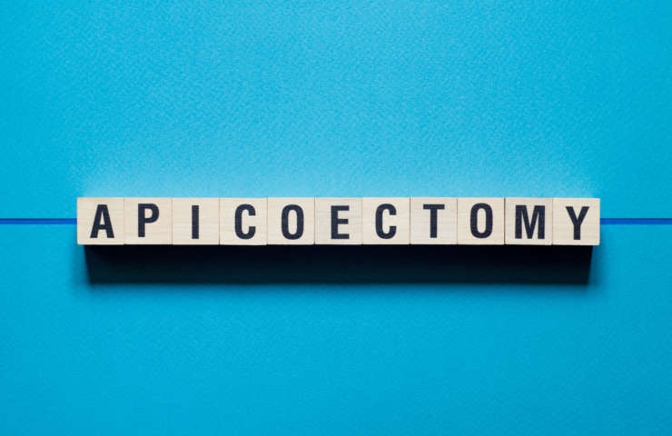 What is Apicoectomy?