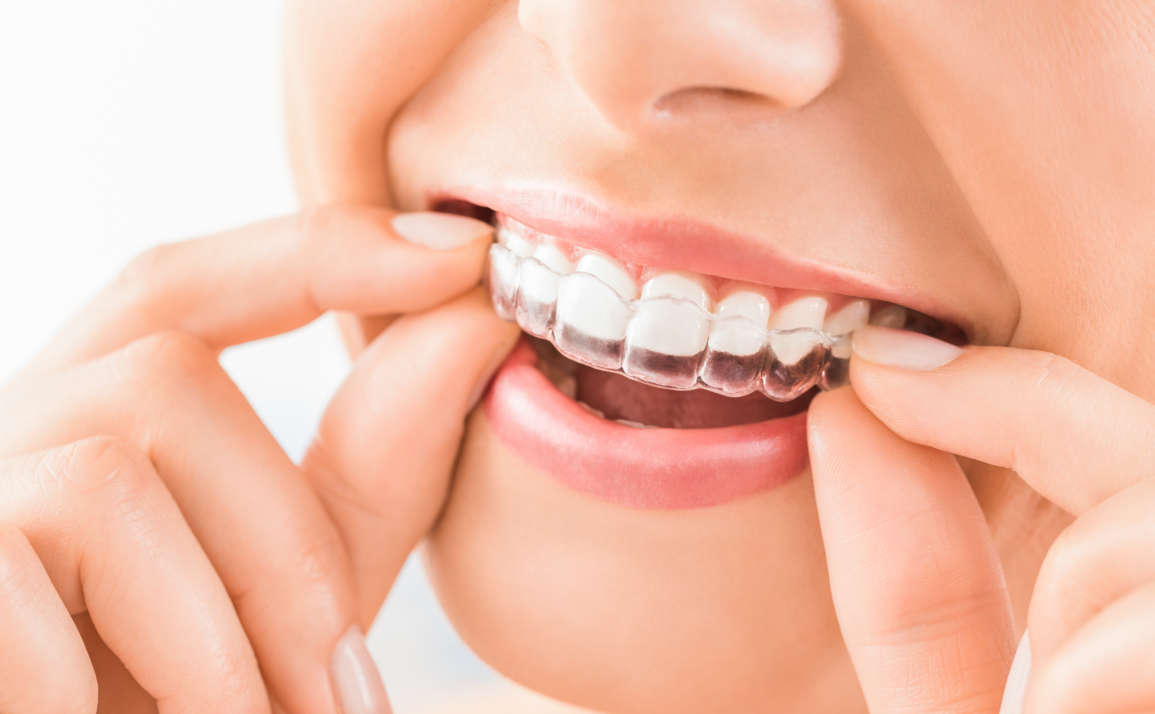 Invisalign