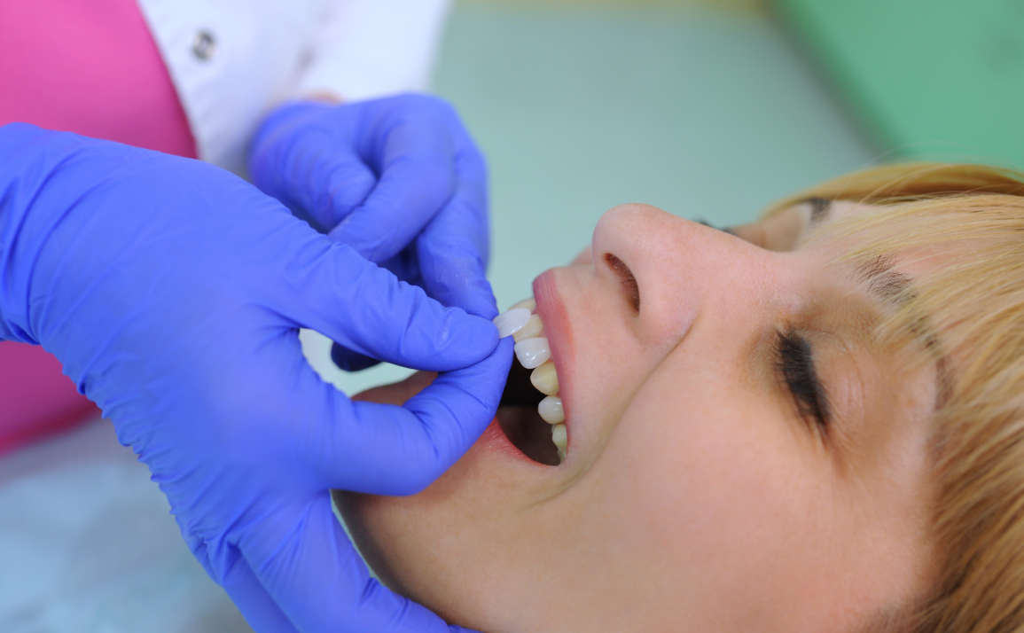 Veneers