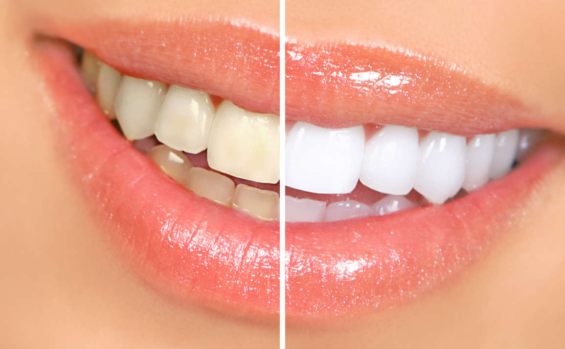 Teeth Whitening