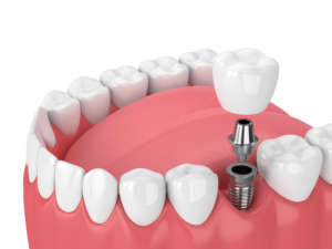 dental implant massachusetts