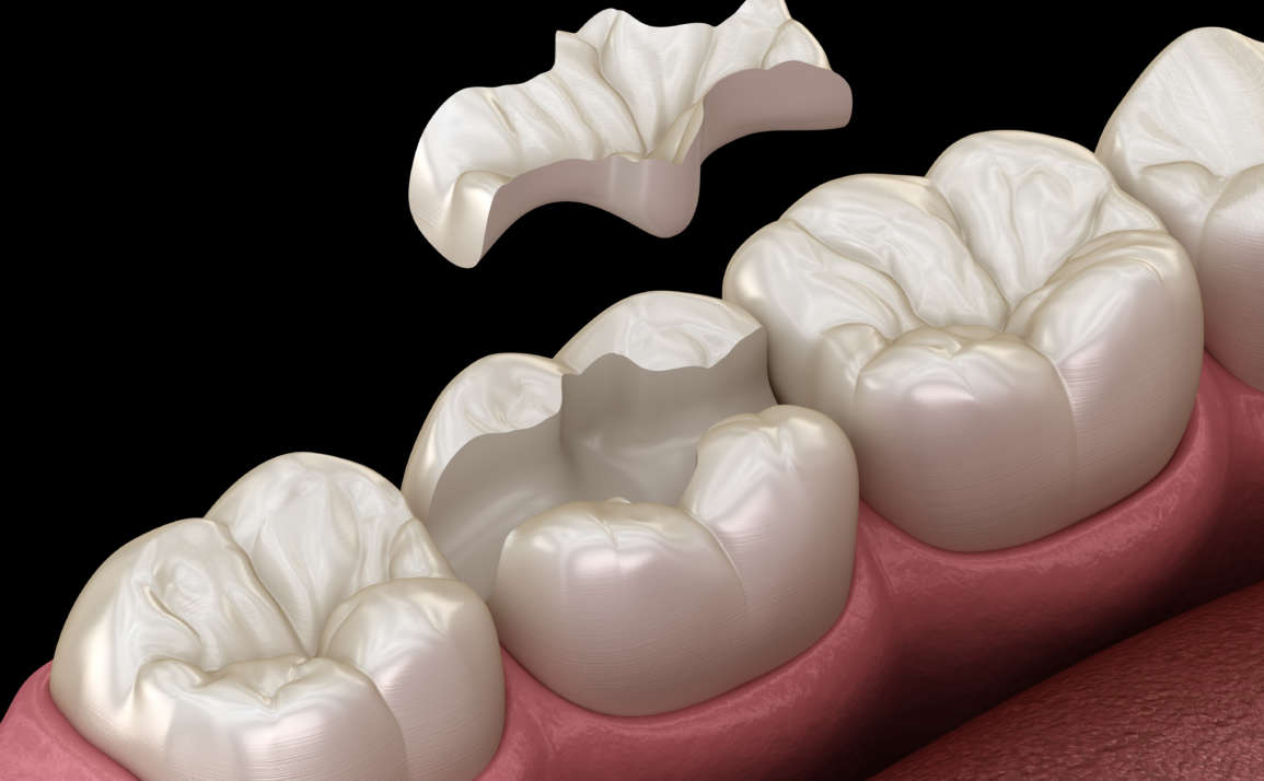MA Dental Inlay Restorations: What You Need To Know