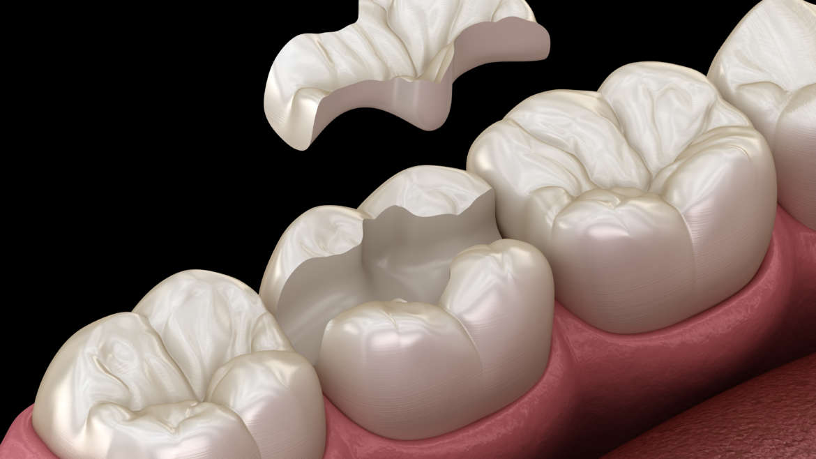 MA Dental Inlay Restorations: What You Need To Know