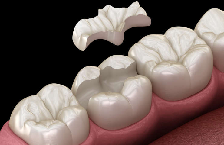 MA Dental Inlay Restorations: What You Need To Know