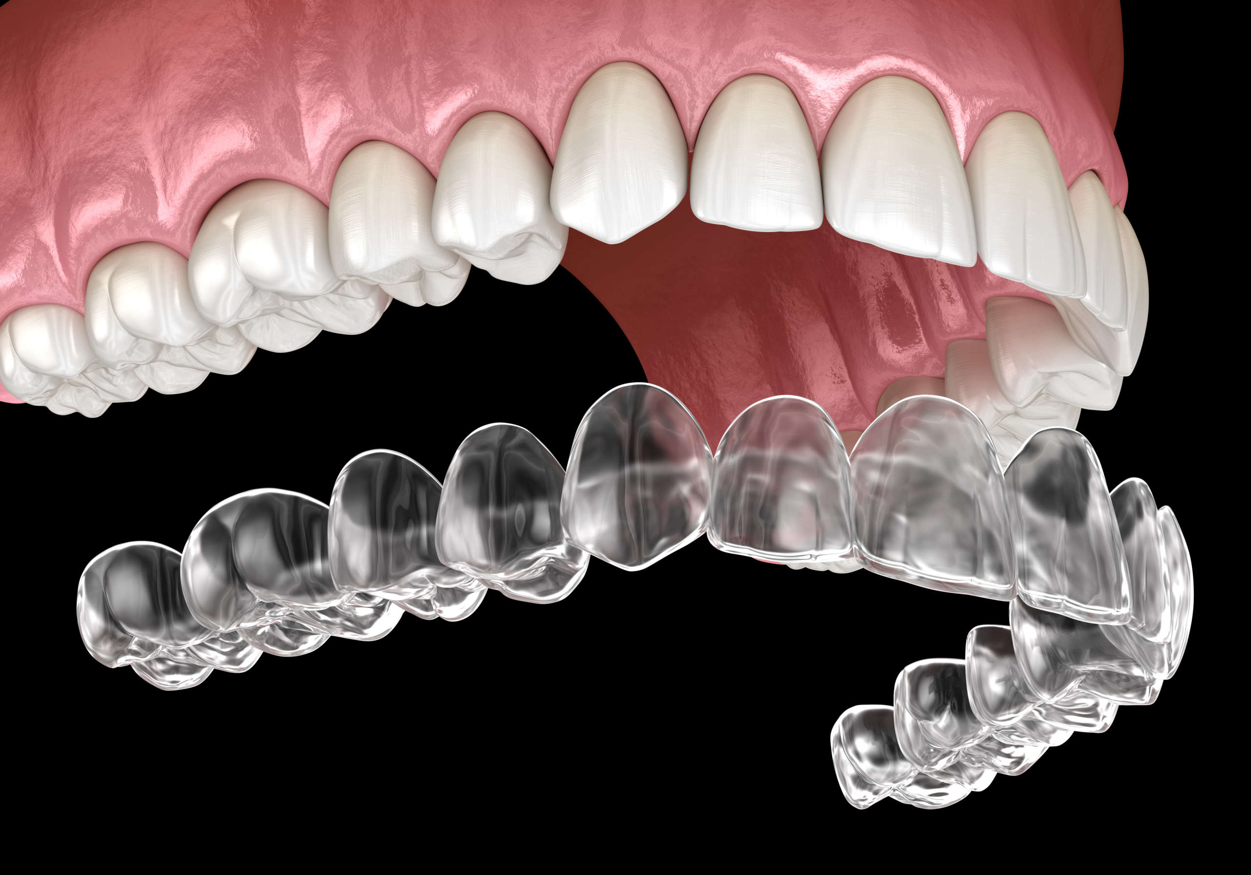 Should You Get Invisalign? Prime Smile Dental Group