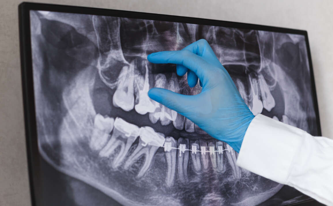 Are Root Canals a Permanent Solution? What to Know About Longevity